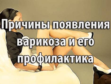 Причины появления варикоза и его профилактика